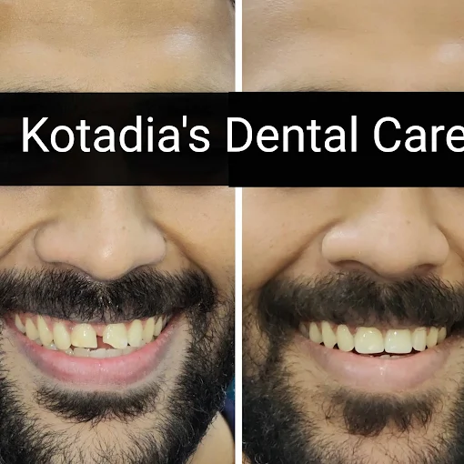 Root Canal Treatment Before and After