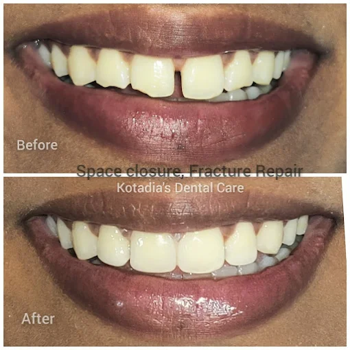 Endodontic Retreatment Before and After