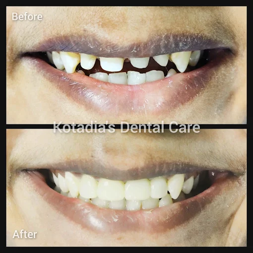 Periapical Surgery Before and After