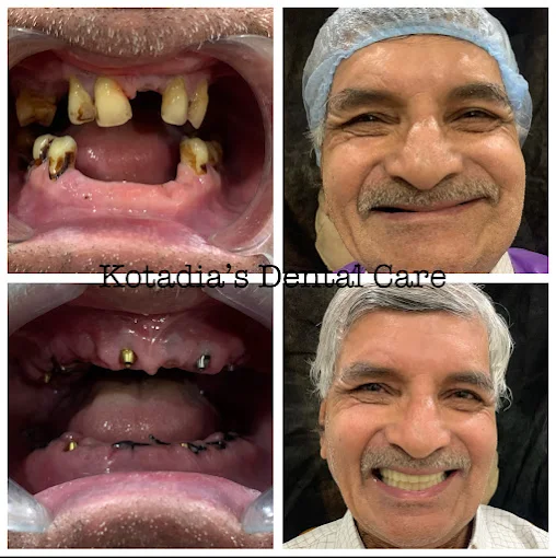 Root Canal Therapy Before and After