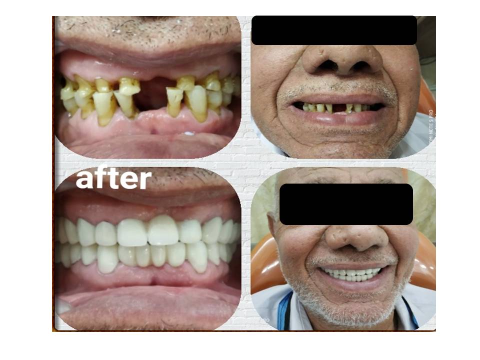 Before and after, full mouth rehabilitation