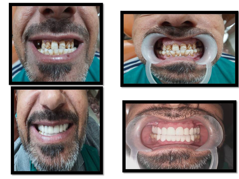 Before and after