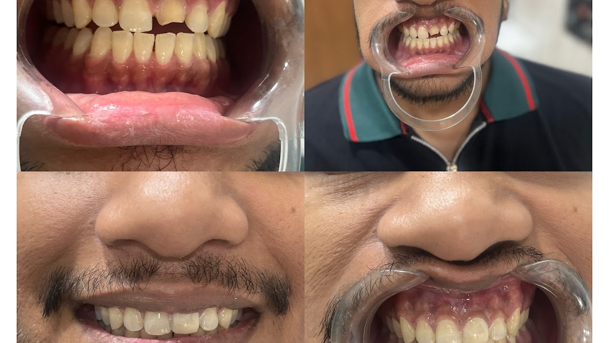 Before and after, smile transformations